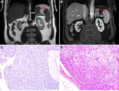 Case report of retroperitoneal ectopic pancreas with adrenal adenoma